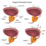 Prostate