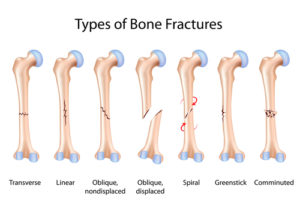 fractures - First Aid Wiki