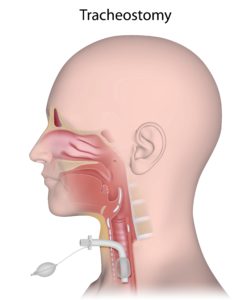 Tracheostomy