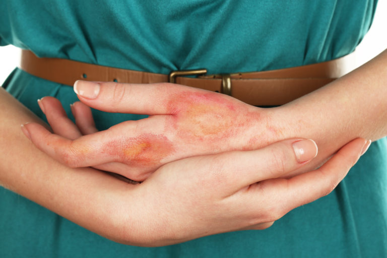 Burns Treatment Using Cling Film