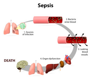 sepsis