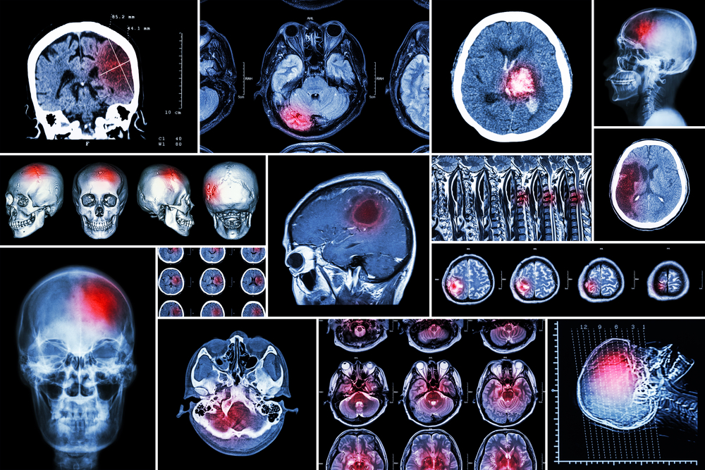 cerebral-compression-first-aid-wiki
