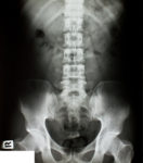 Spinal Injury