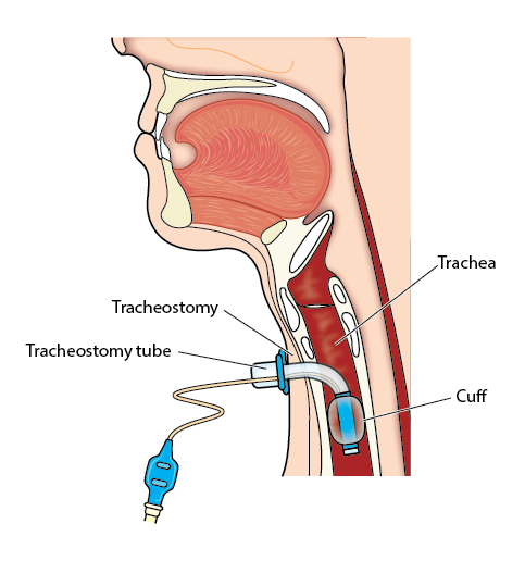 Tracheostomy