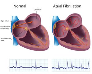 Atrial Fibrillation