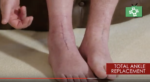total ankle replacement